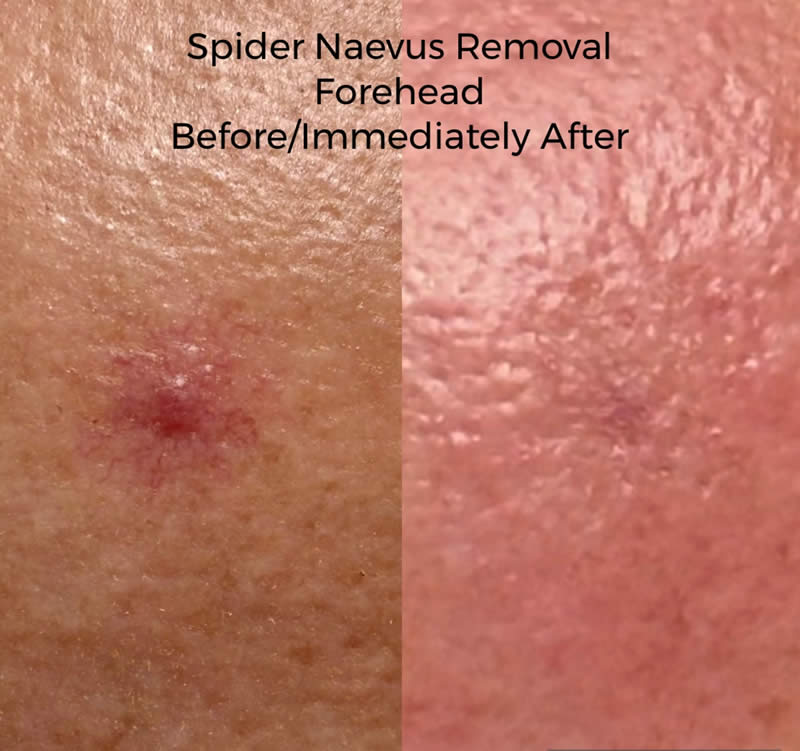 Spider Naevus Removal