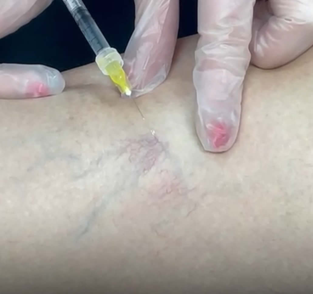 sclerotherapy